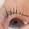 Can eyelash glue cause blepharitis?