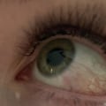 Will eyelash extension allergy go away?