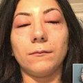How long does it take for eyelash extension allergic reaction to go away?