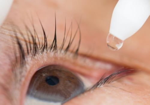 Can eyelash glue cause blepharitis?