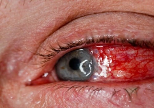 How do you treat a chemical burn on your eyelid?
