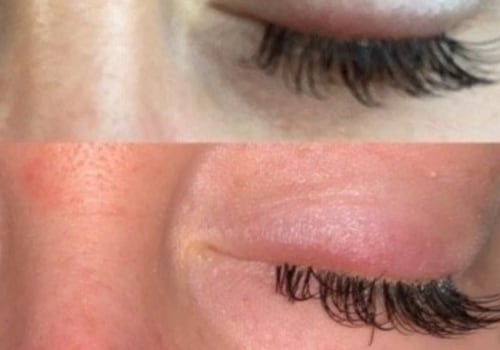 Can eyelash extension glue cause infection?