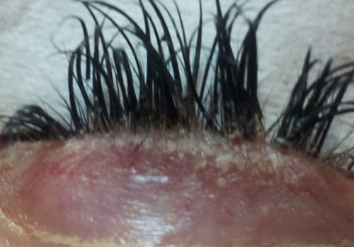 What are the risks of getting eyelash extensions?