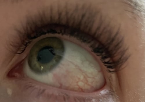 Will eyelash extension allergy go away?