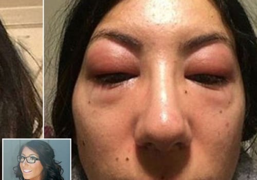 How long does it take for eyelash extension allergic reaction to go away?